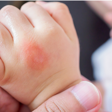 1 Trong 5 Trẻ Em Mắc Phải Dị Ứng Mà Không Được Phát Hiện Kịp Thời. Đừng Để Điều Đó Xảy Ra Với Bé Yêu Của Bạn!