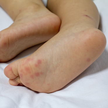 Bệnh Tay Chân Miệng: Những Điều Ba Mẹ Cần Biết Để Bảo Vệ Con Yêu